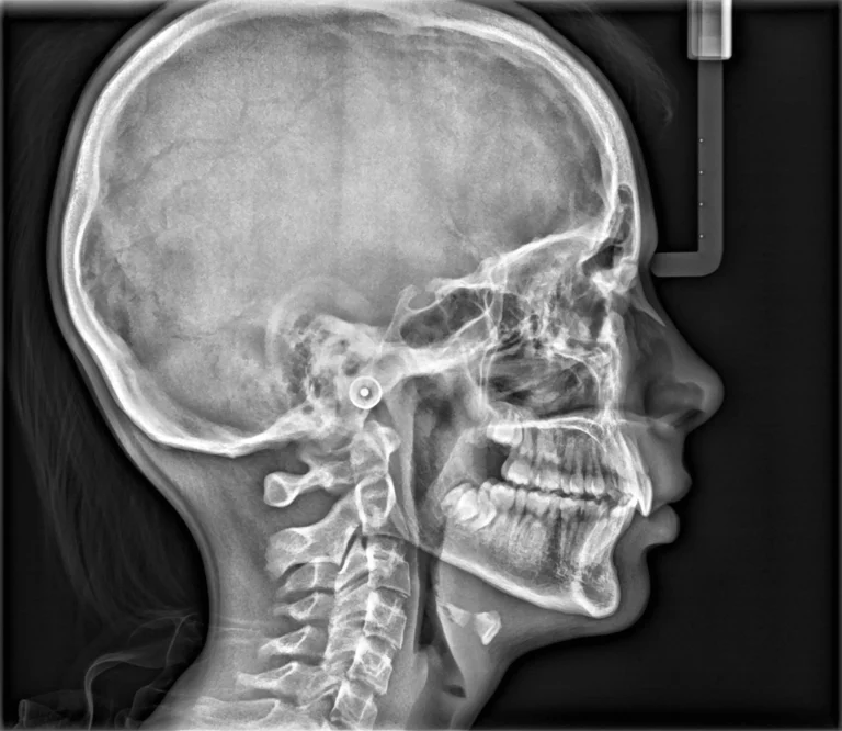 8_cs_9600_scan_ceph_lateral