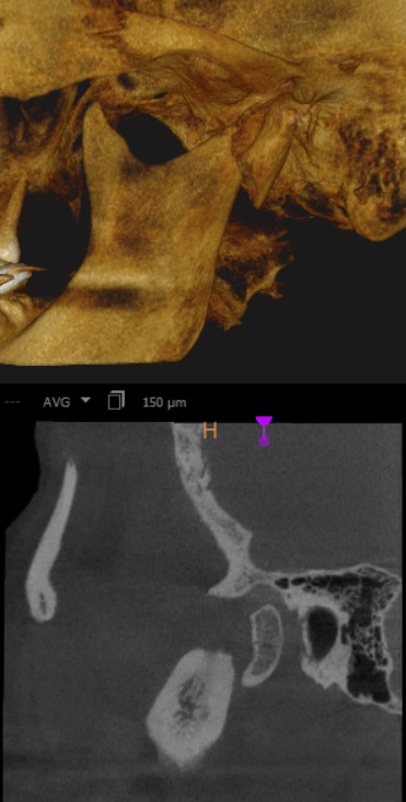 Abudevi_TMJ condylar head fracture