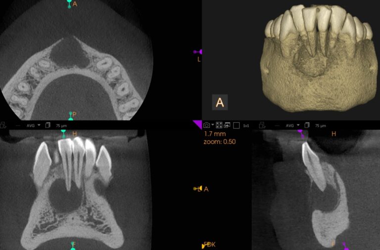 Akshay_Periapical cyst-2