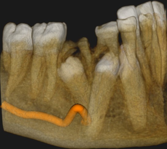 Nagaraju_Impaction-2