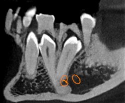 Nagaraju_Impaction-5