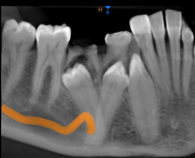 Nagaraju_Impaction-6